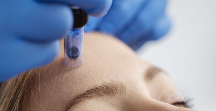 patient-undergoing-microneedling-procedure